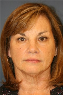 Facelift Before Photo by Steve Laverson, MD, FACS; Rancho Santa Fe, CA - Case 37394