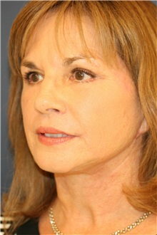 Facelift After Photo by Steve Laverson, MD, FACS; Rancho Santa Fe, CA - Case 37394