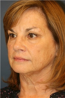 Facelift Before Photo by Steve Laverson, MD, FACS; Rancho Santa Fe, CA - Case 37394