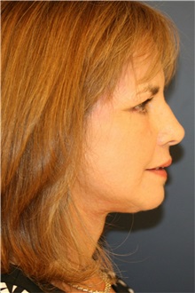 Facelift After Photo by Steve Laverson, MD, FACS; Rancho Santa Fe, CA - Case 37394