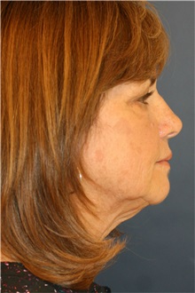 Facelift Before Photo by Steve Laverson, MD, FACS; Rancho Santa Fe, CA - Case 37394