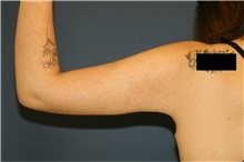 Arm Lift After Photo by Steve Laverson, MD, FACS; Rancho Santa Fe, CA - Case 37559