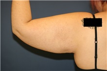 Arm Lift Before Photo by Steve Laverson, MD, FACS; Rancho Santa Fe, CA - Case 37559