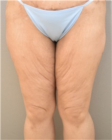 Thigh Lift Before Photo by Keshav Magge, MD; Bethesda, MD - Case 37692