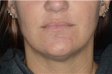 Dermal Fillers After Photo by Landon Pryor, MD, FACS; Rockford, IL - Case 37698