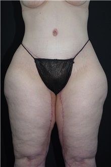 Body Lift After Photo by Landon Pryor, MD, FACS; Rockford, IL - Case 37722