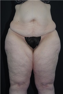 Body Lift Before Photo by Landon Pryor, MD, FACS; Rockford, IL - Case 37722