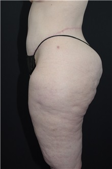 Body Lift After Photo by Landon Pryor, MD, FACS; Rockford, IL - Case 37722