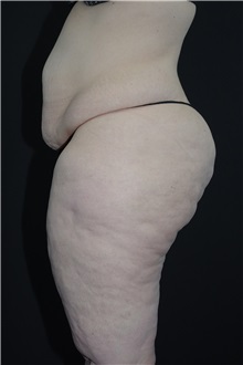 Body Lift Before Photo by Landon Pryor, MD, FACS; Rockford, IL - Case 37722