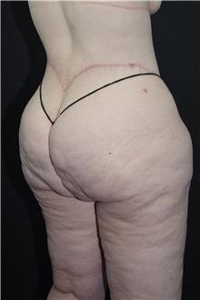 Body Lift After Photo by Landon Pryor, MD, FACS; Rockford, IL - Case 37722