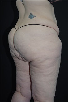 Body Lift Before Photo by Landon Pryor, MD, FACS; Rockford, IL - Case 37722