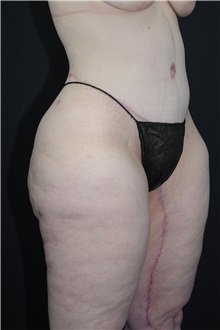 Body Lift After Photo by Landon Pryor, MD, FACS; Rockford, IL - Case 37722