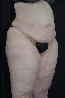 Body Lift Before Photo by Landon Pryor, MD, FACS; Rockford, IL - Case 37722