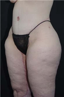 Body Lift After Photo by Landon Pryor, MD, FACS; Rockford, IL - Case 37722