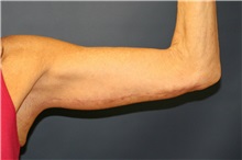 Arm Lift After Photo by Steve Laverson, MD, FACS; Rancho Santa Fe, CA - Case 37728