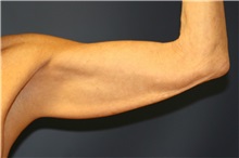 Arm Lift Before Photo by Steve Laverson, MD, FACS; Rancho Santa Fe, CA - Case 37728