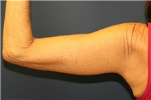 Arm Lift After Photo by Steve Laverson, MD, FACS; Rancho Santa Fe, CA - Case 37728