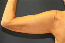 Arm Lift Before Photo by Steve Laverson, MD, FACS; Rancho Santa Fe, CA - Case 37728