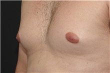 Male Breast Reduction Before Photo by Landon Pryor, MD, FACS; Rockford, IL - Case 37737