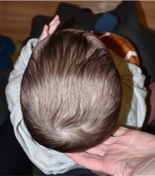 Craniosynostosis After Photo by Rachel Ruotolo, MD; Garden City, NY - Case 37786