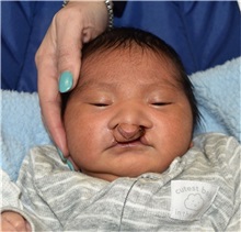 Cleft Lip and Palate Repair Before Photo by Rachel Ruotolo, MD; Garden City, NY - Case 37794