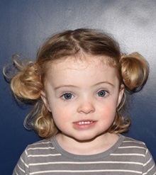 Craniosynostosis After Photo by Rachel Ruotolo, MD; Garden City, NY - Case 37805