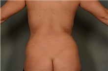 Liposuction After Photo by Ellen Janetzke, MD; Bloomfield Hills, MI - Case 37837