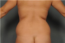 Liposuction Before Photo by Ellen Janetzke, MD; Bloomfield Hills, MI - Case 37837