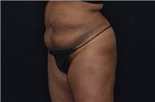 Buttock Lift with Augmentation After Photo by Landon Pryor, MD, FACS; Rockford, IL - Case 37949