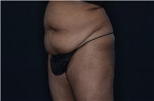 Buttock Lift with Augmentation Before Photo by Landon Pryor, MD, FACS; Rockford, IL - Case 37949