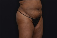 Buttock Lift with Augmentation After Photo by Landon Pryor, MD, FACS; Rockford, IL - Case 37949