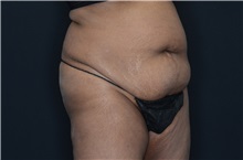 Buttock Lift with Augmentation Before Photo by Landon Pryor, MD, FACS; Rockford, IL - Case 37949