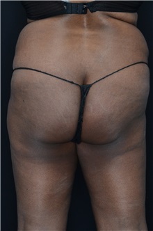 Buttock Lift with Augmentation Before Photo by Landon Pryor, MD, FACS; Rockford, IL - Case 37949