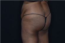 Buttock Lift with Augmentation Before Photo by Landon Pryor, MD, FACS; Rockford, IL - Case 37949