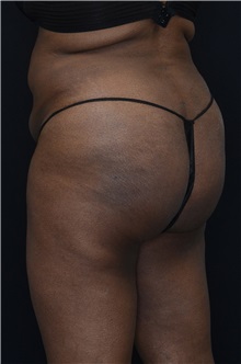 Buttock Lift with Augmentation After Photo by Landon Pryor, MD, FACS; Rockford, IL - Case 37949