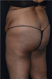 Buttock Lift with Augmentation Before Photo by Landon Pryor, MD, FACS; Rockford, IL - Case 37949