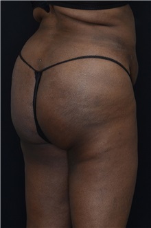 Buttock Lift with Augmentation After Photo by Landon Pryor, MD, FACS; Rockford, IL - Case 37949