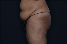 Buttock Lift with Augmentation Before Photo by Landon Pryor, MD, FACS; Rockford, IL - Case 37949