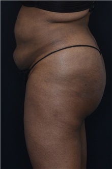 Buttock Lift with Augmentation After Photo by Landon Pryor, MD, FACS; Rockford, IL - Case 37949