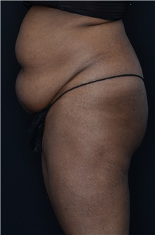 Buttock Lift with Augmentation Before Photo by Landon Pryor, MD, FACS; Rockford, IL - Case 37949