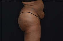 Buttock Lift with Augmentation After Photo by Landon Pryor, MD, FACS; Rockford, IL - Case 37949