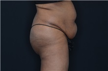 Buttock Lift with Augmentation Before Photo by Landon Pryor, MD, FACS; Rockford, IL - Case 37949