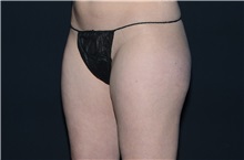 Liposuction Before Photo by Landon Pryor, MD, FACS; Rockford, IL - Case 37958