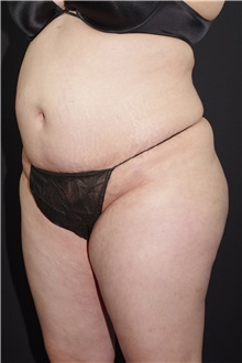 Buttock Lift with Augmentation After Photo by Landon Pryor, MD, FACS; Rockford, IL - Case 37963