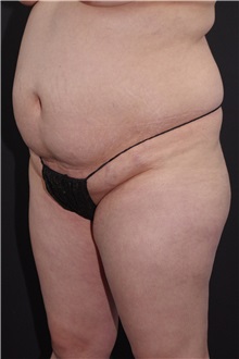 Buttock Lift with Augmentation Before Photo by Landon Pryor, MD, FACS; Rockford, IL - Case 37963