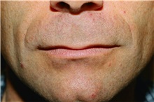 Lip Augmentation/Enhancement Before Photo by Steve Laverson, MD, FACS; Rancho Santa Fe, CA - Case 37984