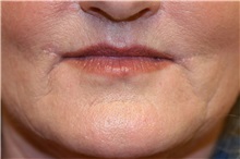 Lip Augmentation/Enhancement After Photo by Steve Laverson, MD, FACS; Rancho Santa Fe, CA - Case 37988