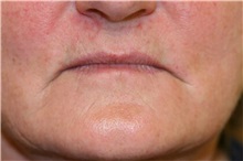 Lip Augmentation/Enhancement Before Photo by Steve Laverson, MD, FACS; Rancho Santa Fe, CA - Case 37988