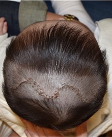 Craniosynostosis After Photo by Rachel Ruotolo, MD; Garden City, NY - Case 37997