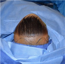 Craniosynostosis Before Photo by Rachel Ruotolo, MD; Garden City, NY - Case 38010